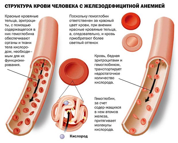 Признаки железодефицитной анемии у детей