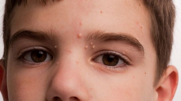 Контагиозный моллюск у детей: что делать, если у ребенка выявили патологию?