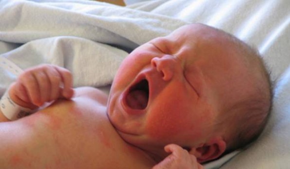 Как проявляется аллергия у новорожденных и чем ее лечить