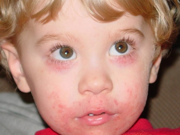 Контактный дерматит у детей: причины, формы и лечение